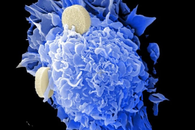 Nanotehnologia poate veni în sprijinul tratamentelor împotriva cancerului
