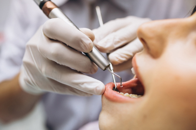 23 de milioane de implanturi dentare se vând anual în lume
